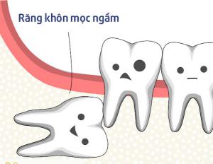 Không mọc răng khôn có nguy hiểm không?