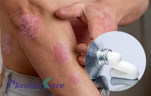 Review thực tế: Top 5 thuốc bôi vảy nến hiệu quả nhất được dược sỹ khuyên dùng